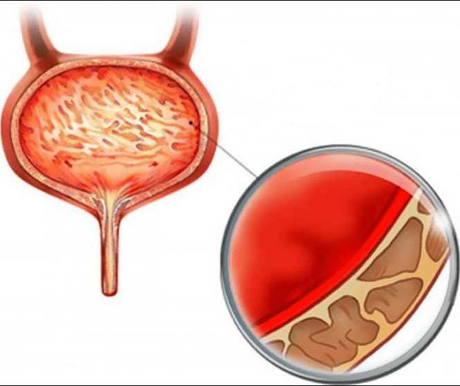 Cystitis