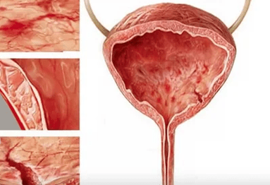 Reasons for the development of cystitis in women